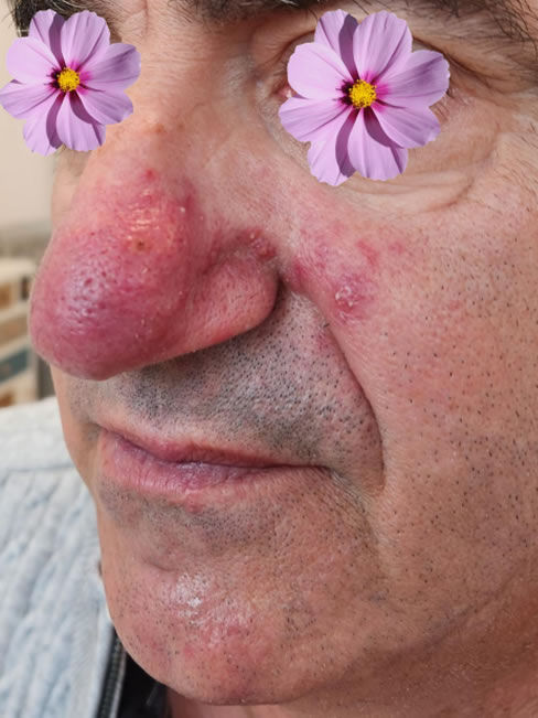 rosacea-1