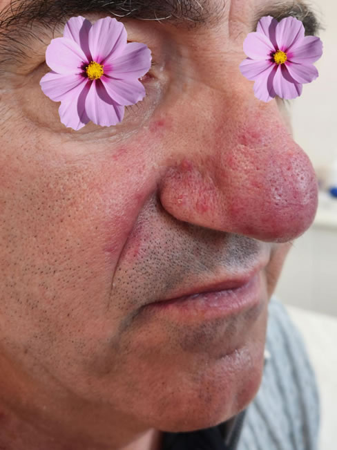 rosacea-2