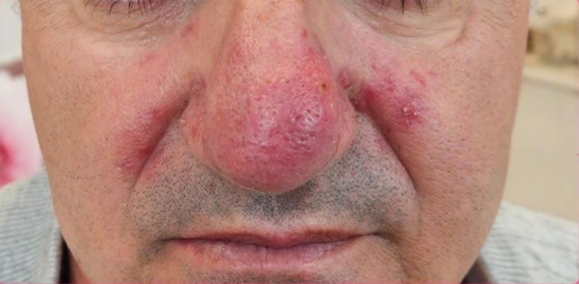 rosacea-3